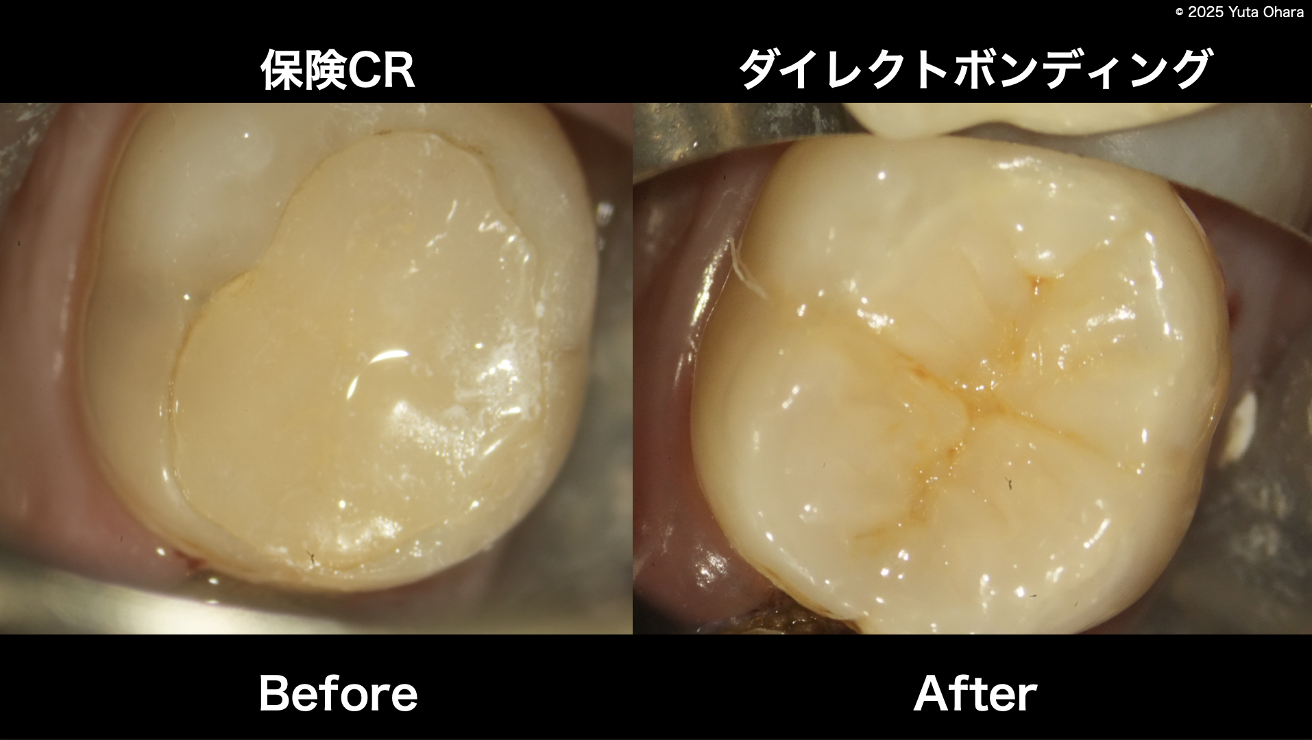 ラバーダム下 ダイレクトボンディング治療