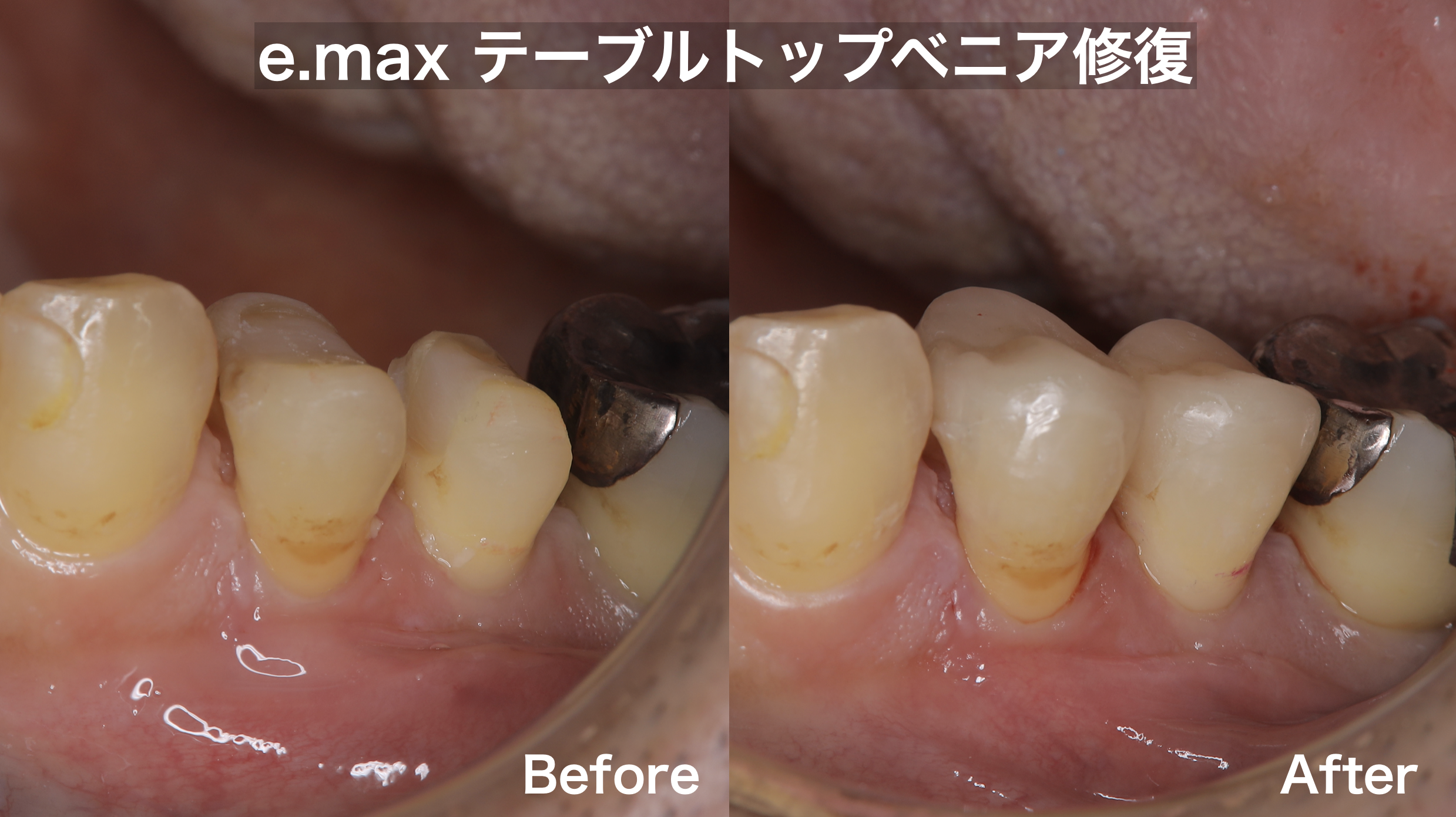 ラバーダム下 e.max テーブルトップベニア