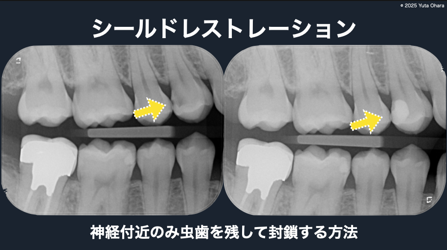 ラバーダム下 シールドレストレーション法