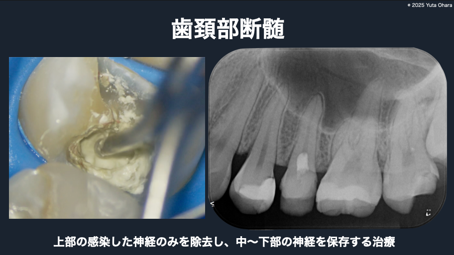 ラバーダム下 歯頚部断髄法