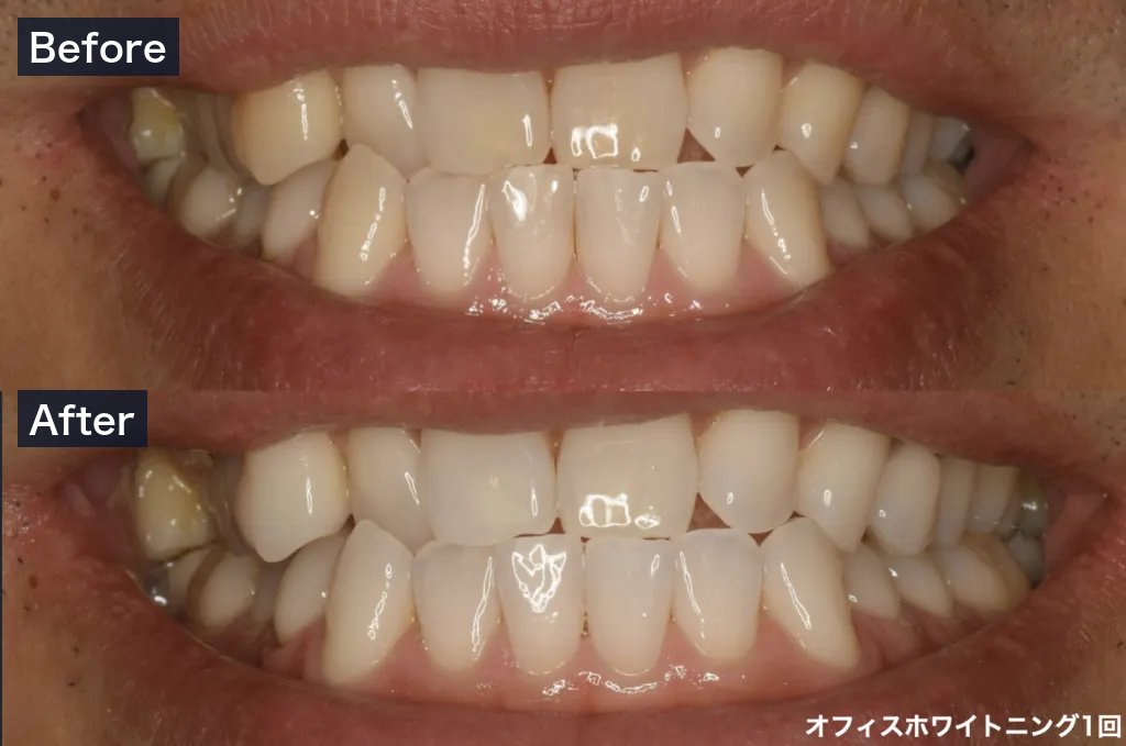 オフィスホワイトニング1回の症例（Before・After）