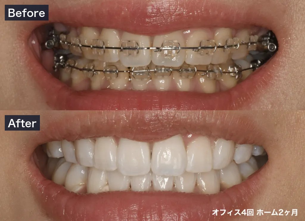 オフィスホワイトニング4回とホームホワイトニング2ヶ月の症例（Before・After）