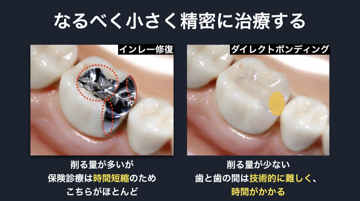 なるべく小さく精密に治療する（インレー修復とダイレクトボンディングの比較）