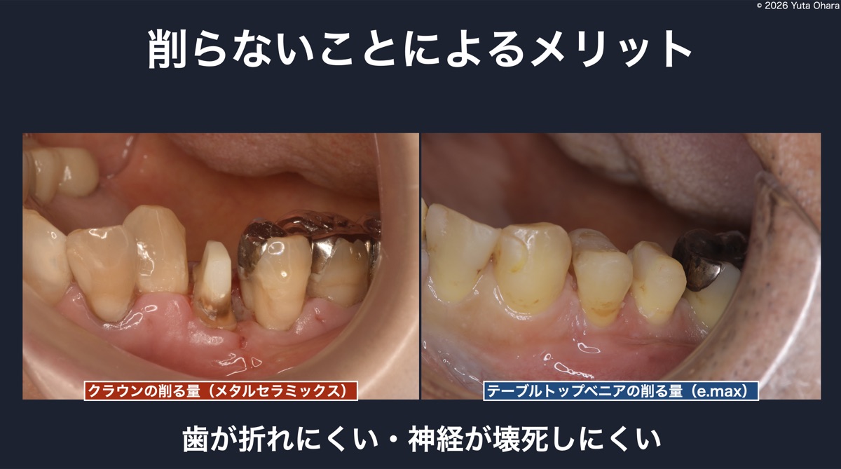 削らないことによるメリット（クラウンとテーブルトップベニアの削る量の比較）