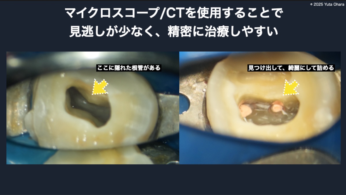 マイクロスコープとCTを使用した根管治療の説明
