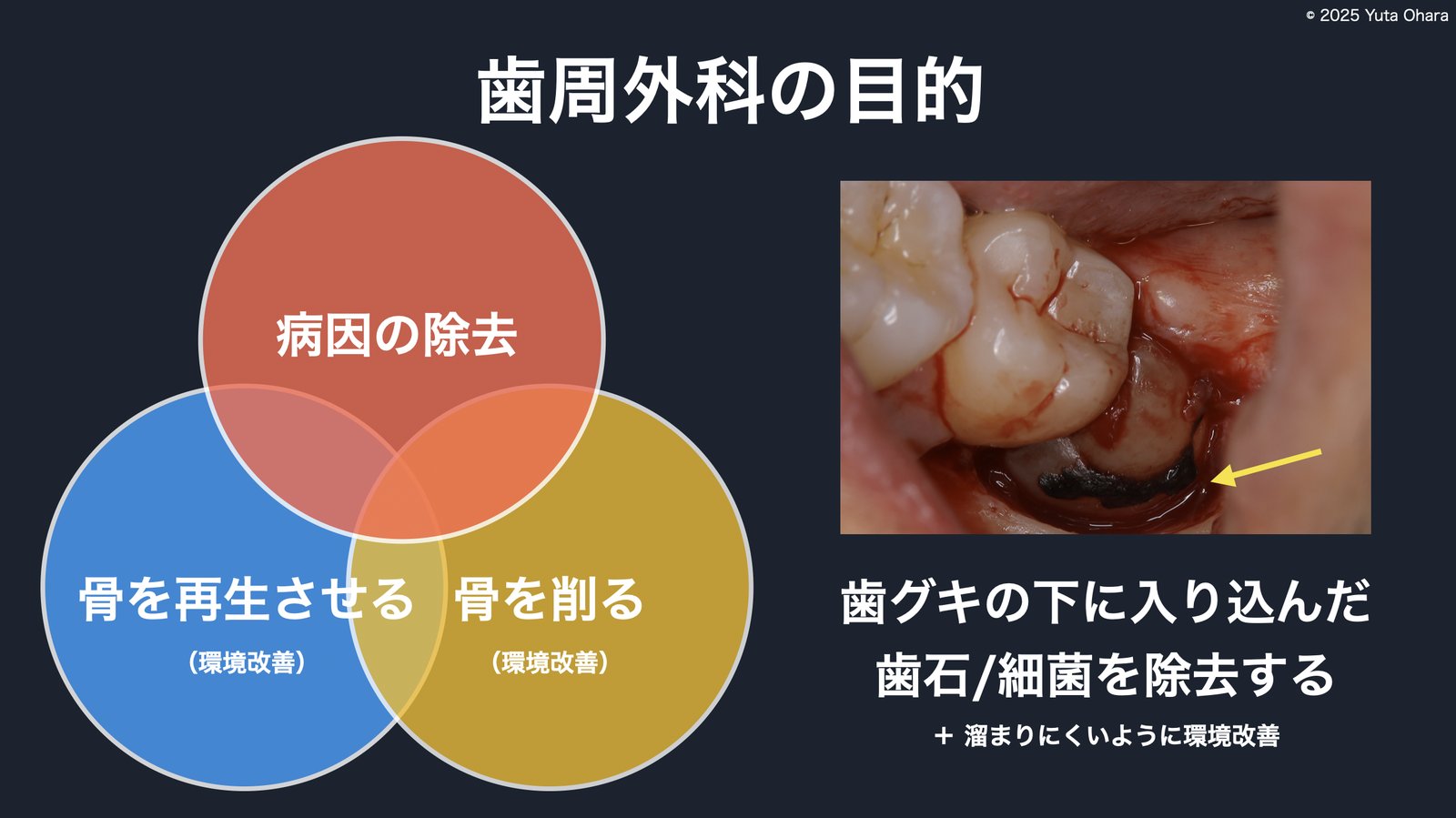 歯周外科の目的の解説（病因の除去・骨の再生・環境改善）