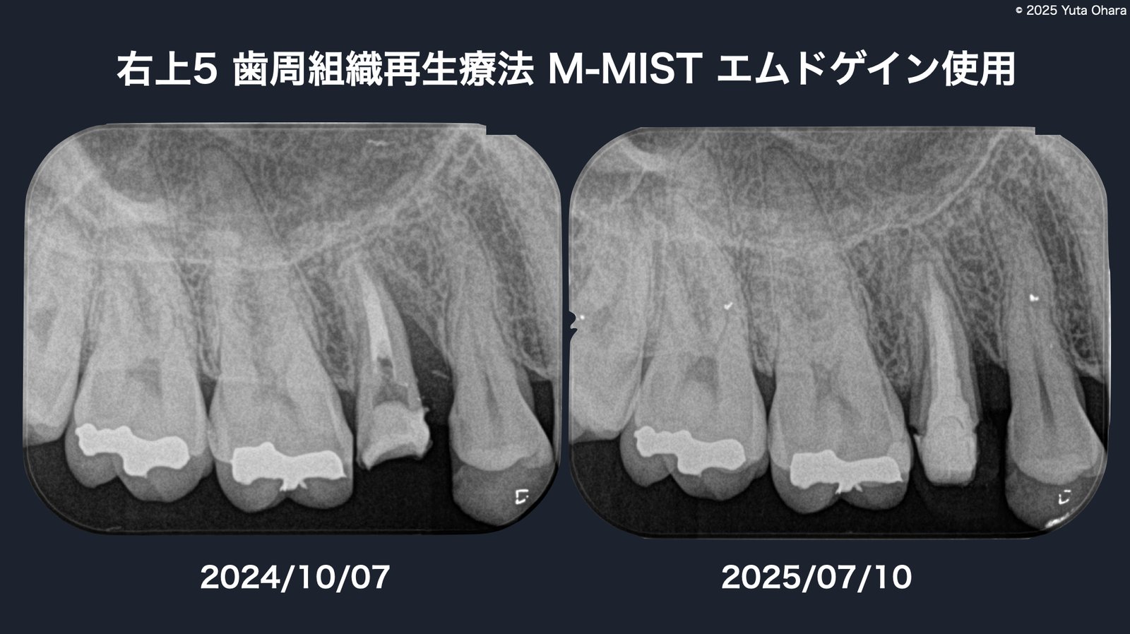 歯周組織再生療法（M-MIST・エムドゲイン使用）の術前後X線