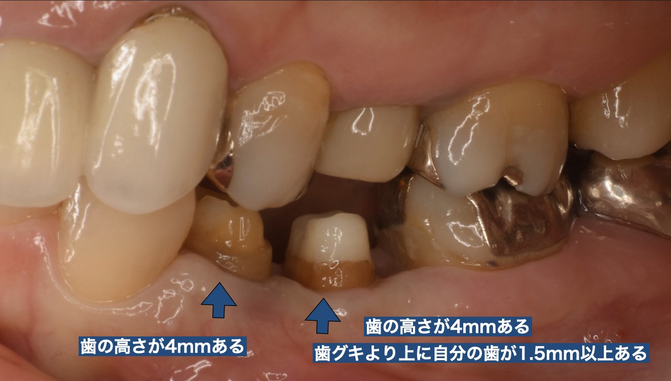 クラウンレングスニング後：歯の高さ約4mmを確保