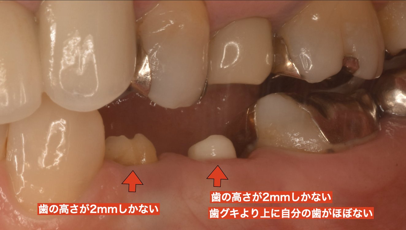 治療前：歯グキより上の歯の高さが約2mmしかない状態