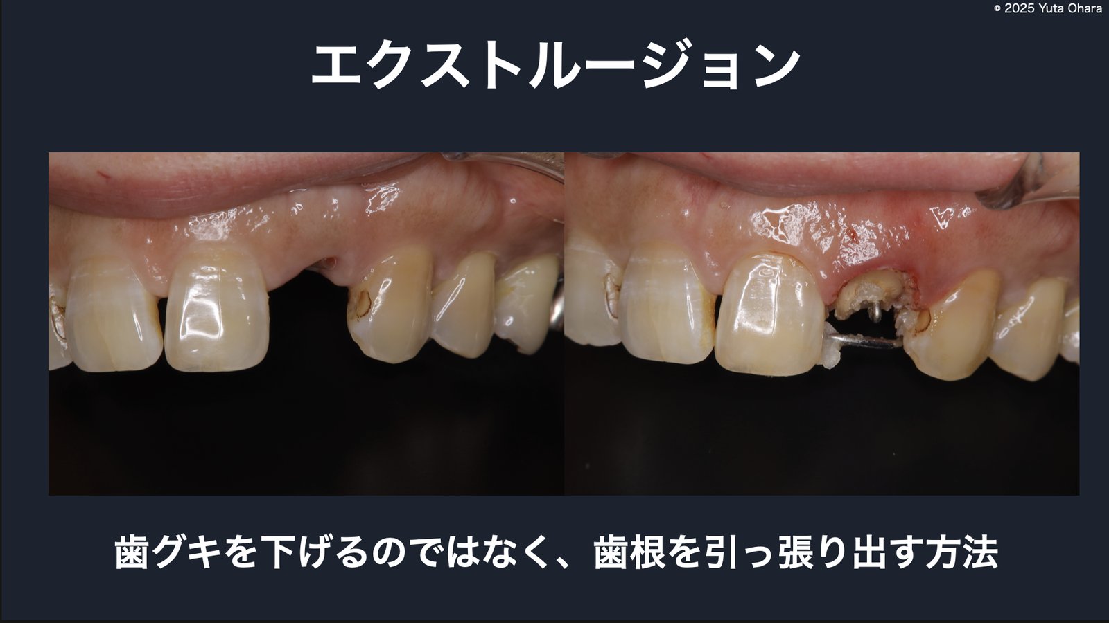 エクストルージョンの解説（歯根を引っ張り出す方法）
