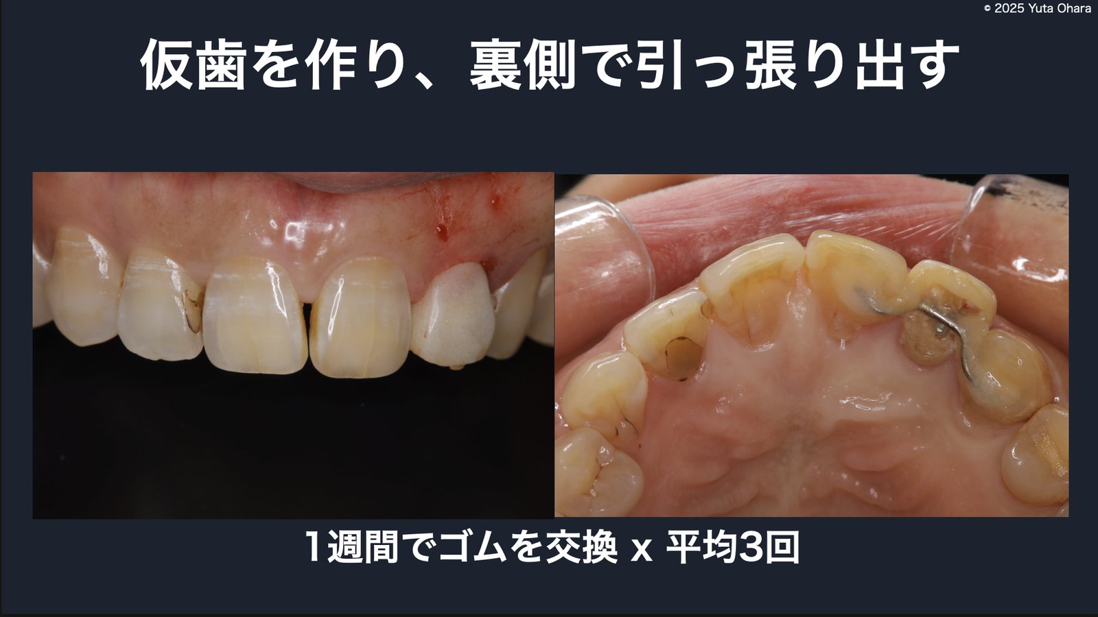 仮歯を作り裏側のゴムで歯根を引き出す仕組み