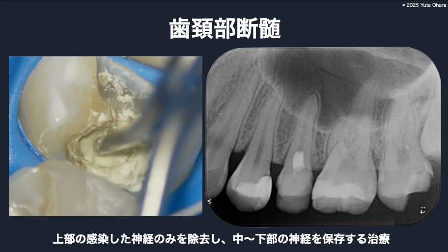 歯頚部断髄の解説（マイクロスコープ視野とX線）
