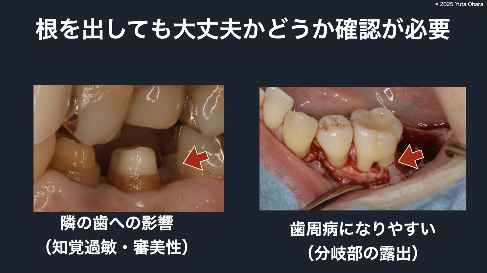 適応確認の解説（隣の歯への影響・歯周病リスク）