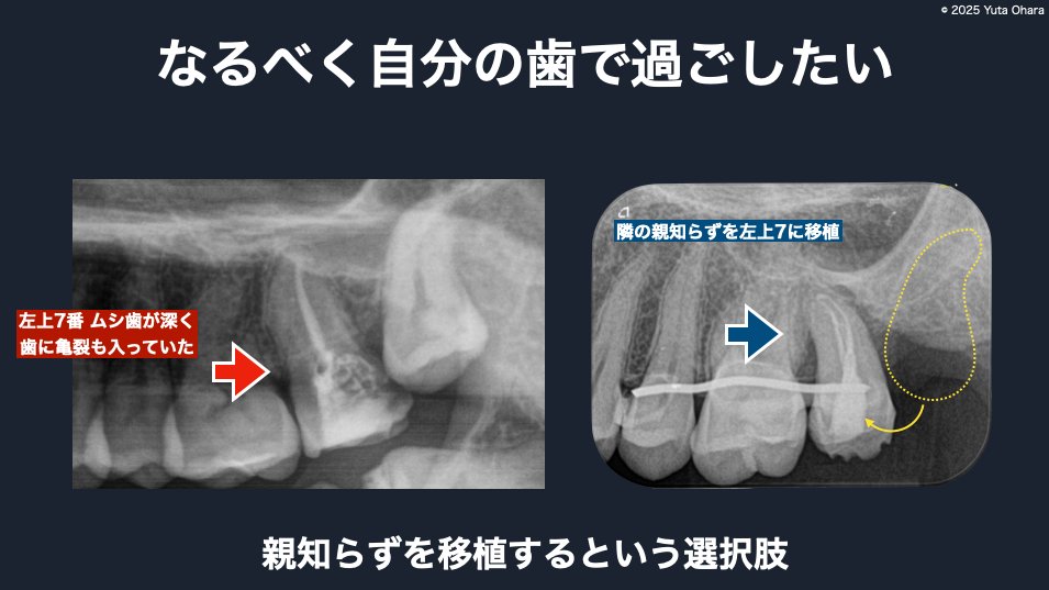 自家歯牙移植の症例（左上7番へ親知らずを移植）