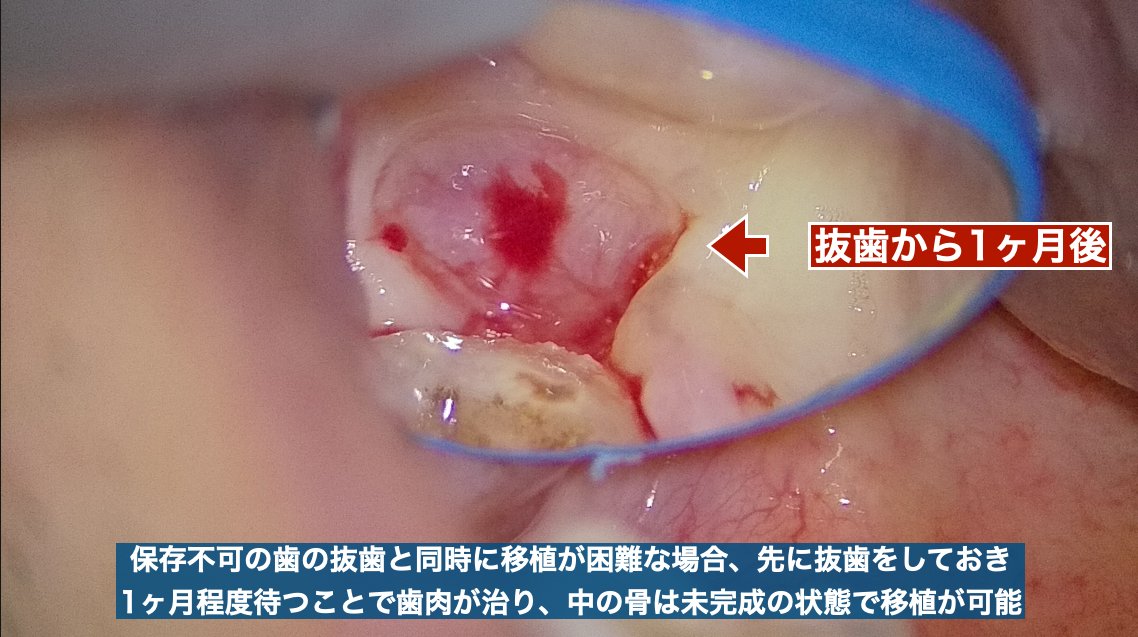 抜歯から1ヶ月後の状態