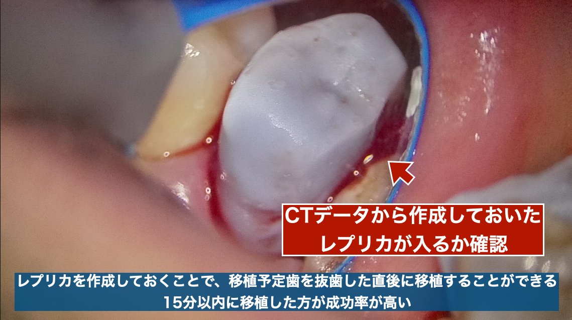 CTデータから作成したレプリカで適合を確認