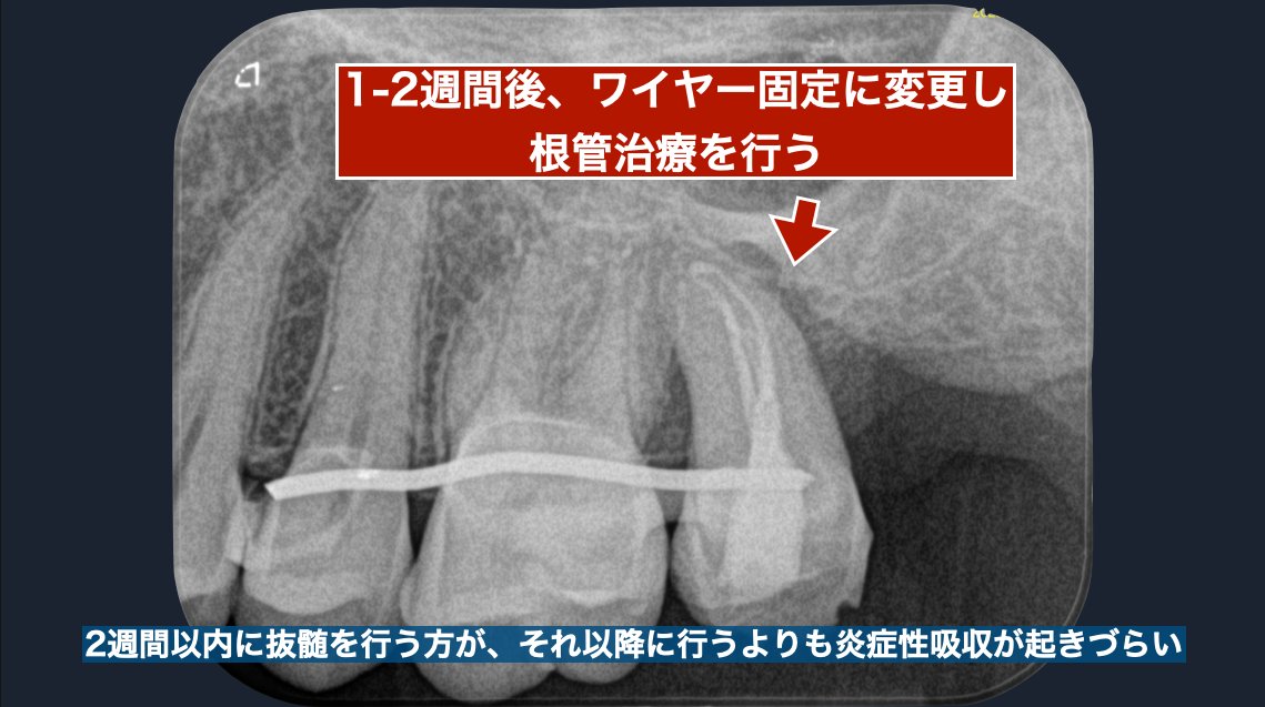 ワイヤー固定に変更し根管治療