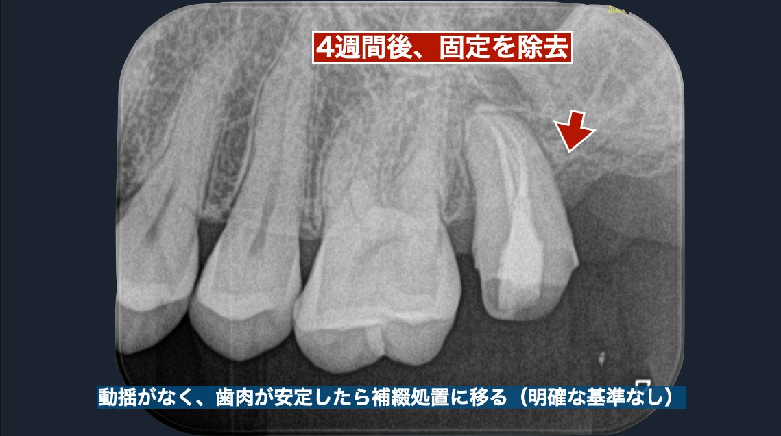 4週間後に固定を除去
