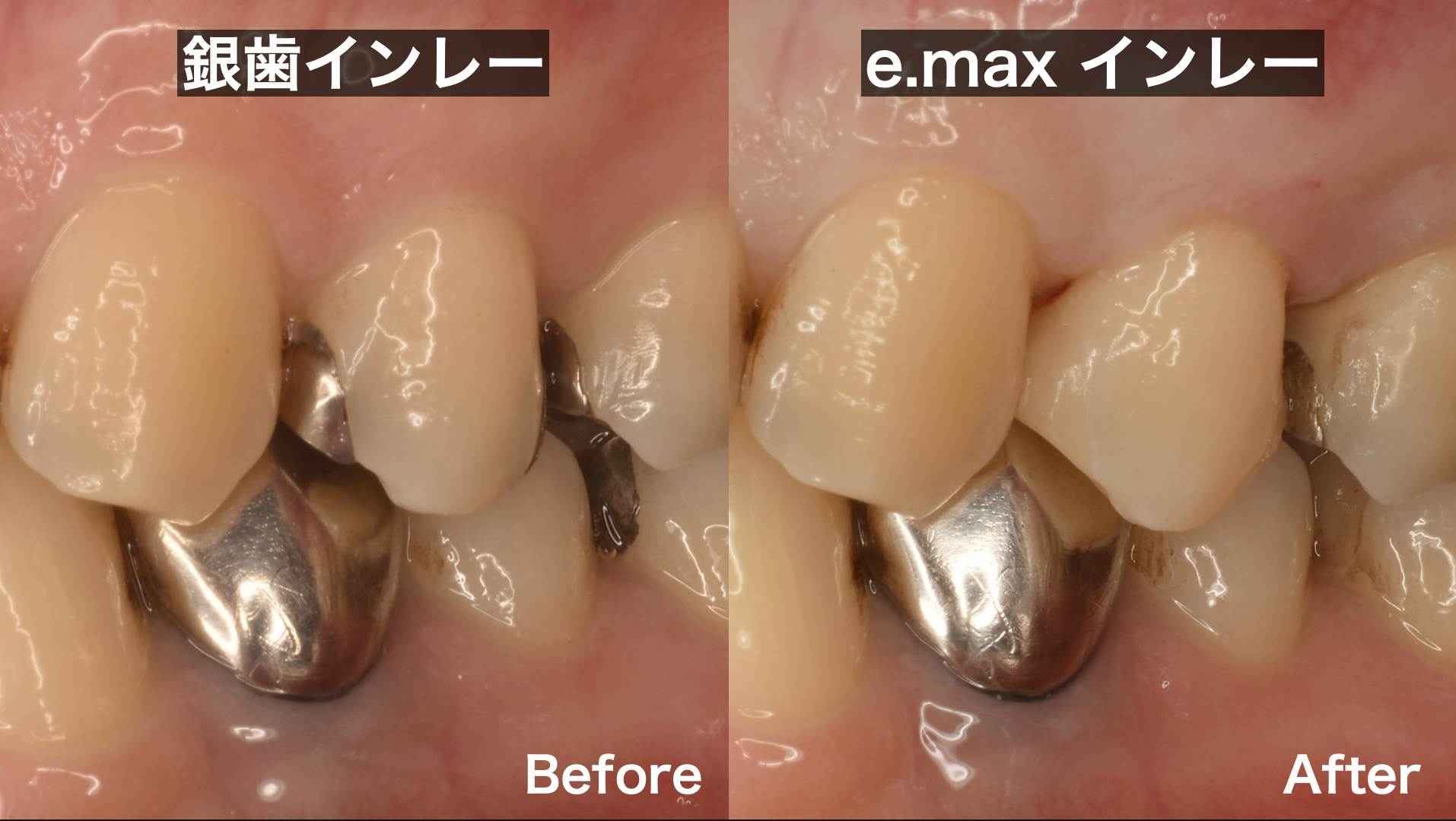 e.max・ジルコニア