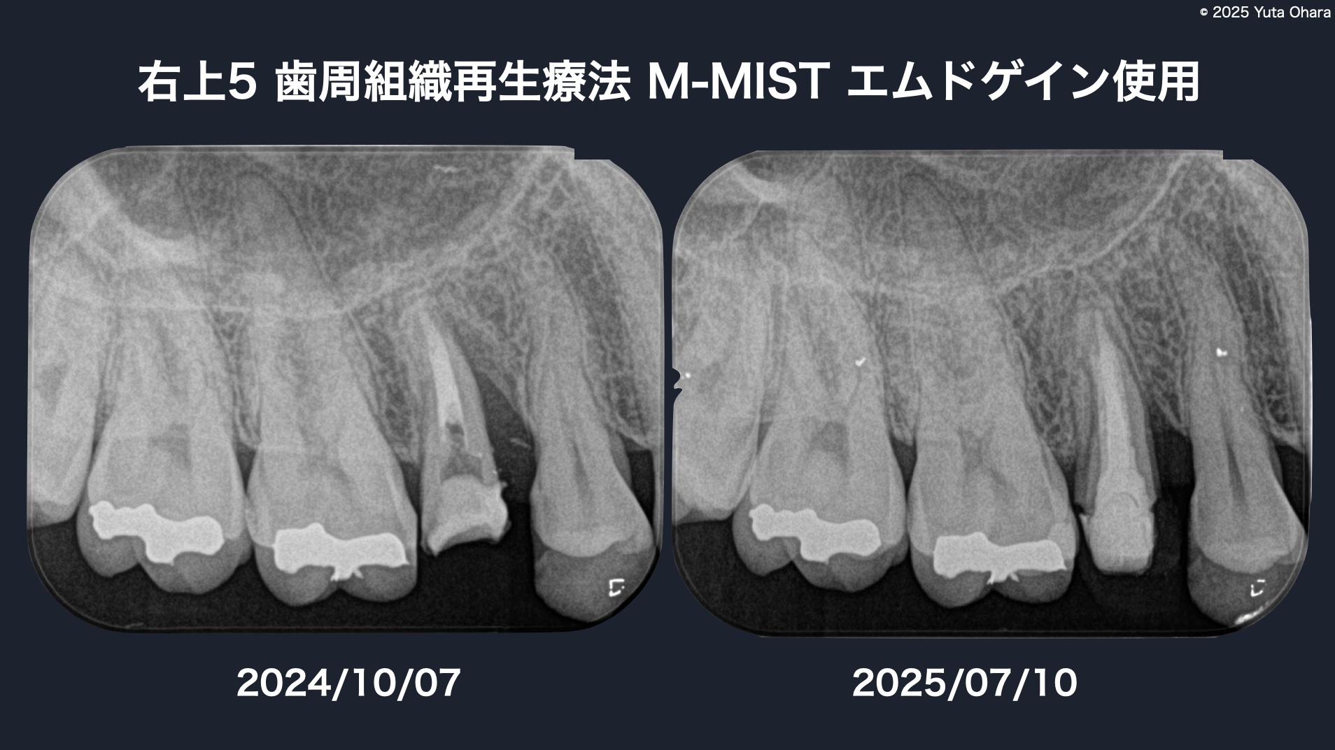 歯周組織再生療法