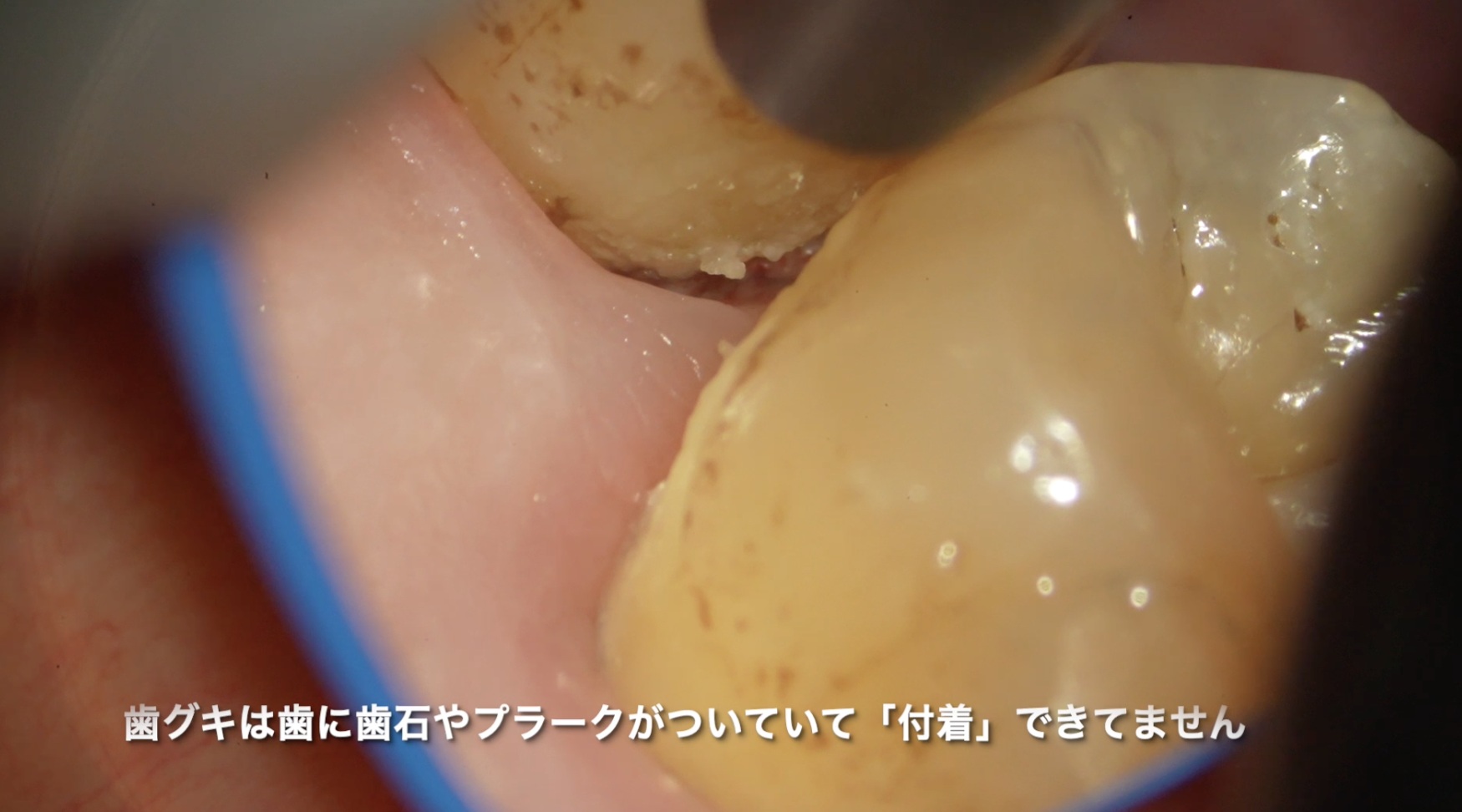 歯周病＝付着の喪失