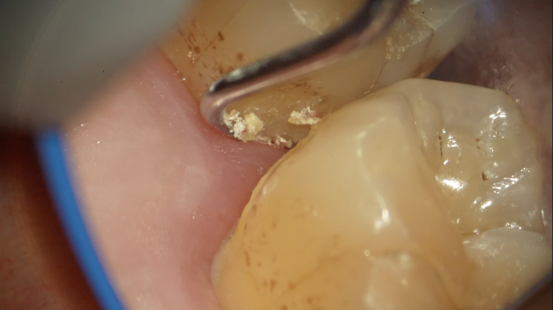 歯石は歯磨きでは取れない。