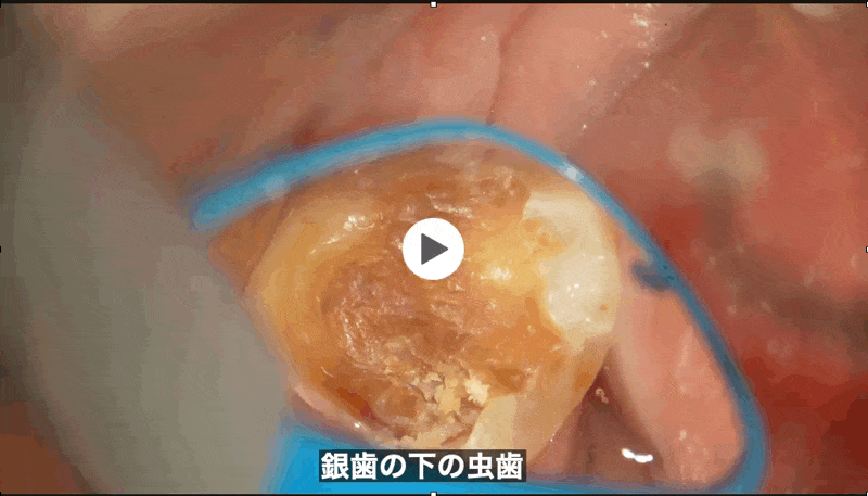 銀歯の下の虫歯