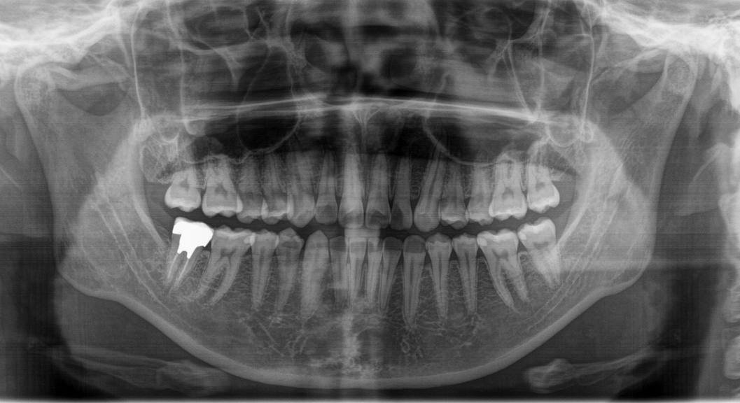 パノラマX線写真