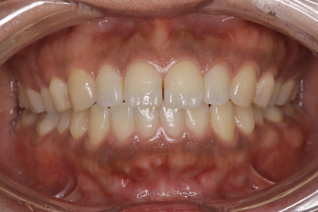 ガムピーリング2