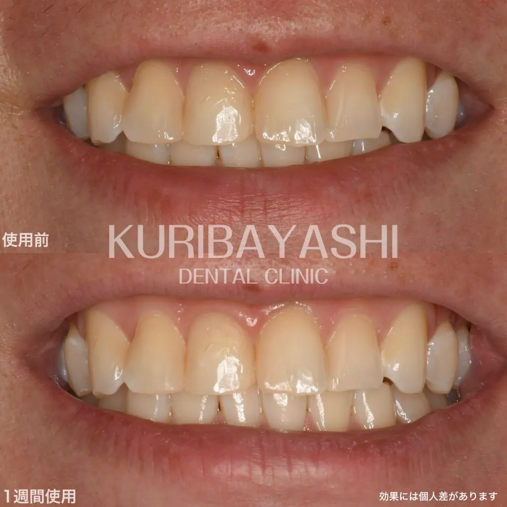 ホワイトニング歯磨き粉